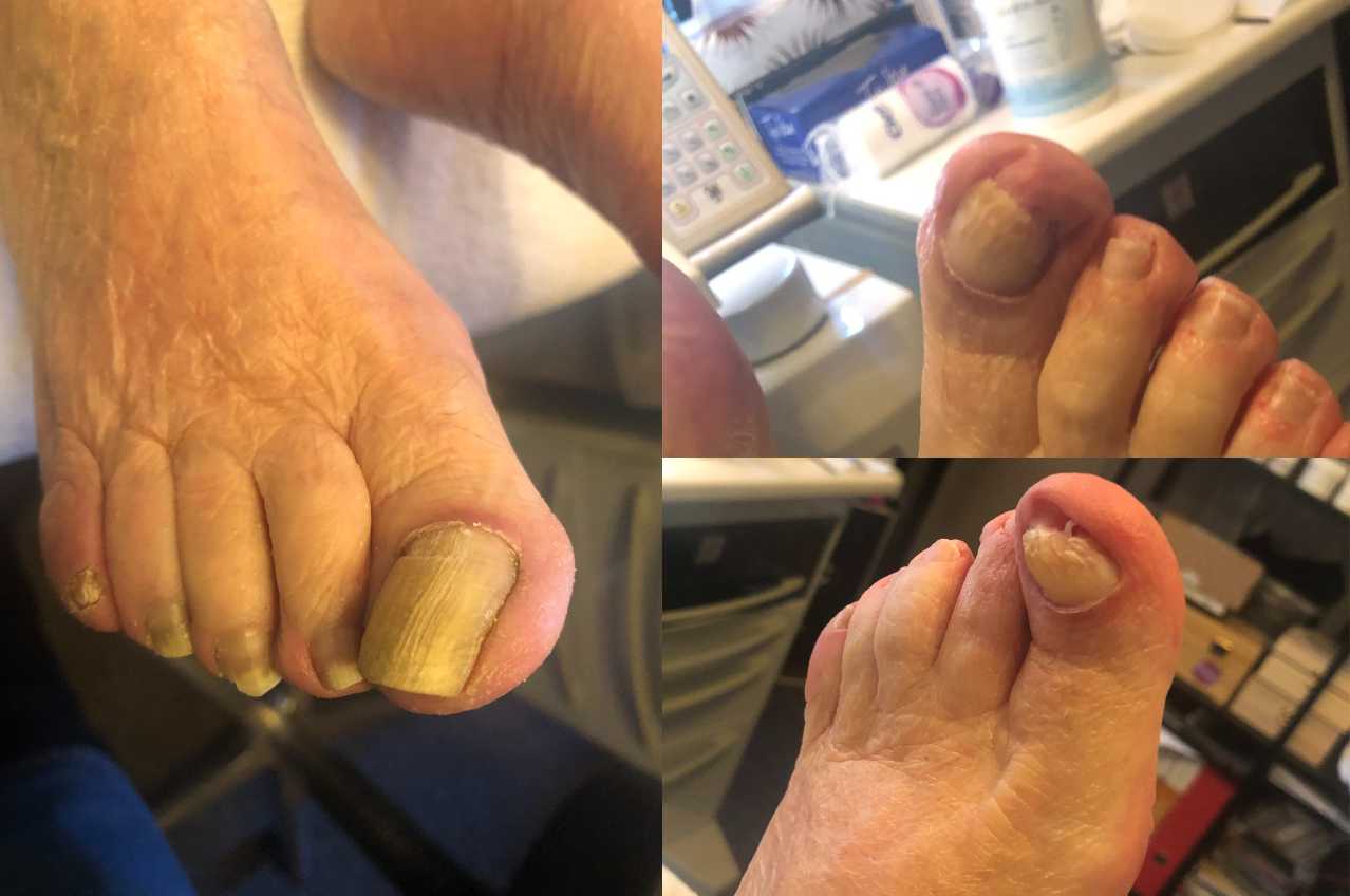 medisch pedicure hoenderloo
