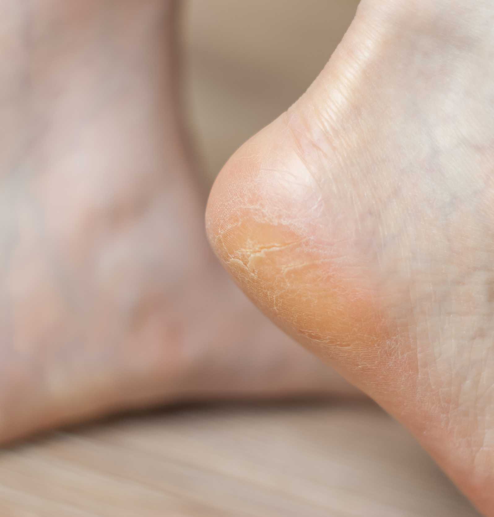 Medisch pedicure Hoenderloo