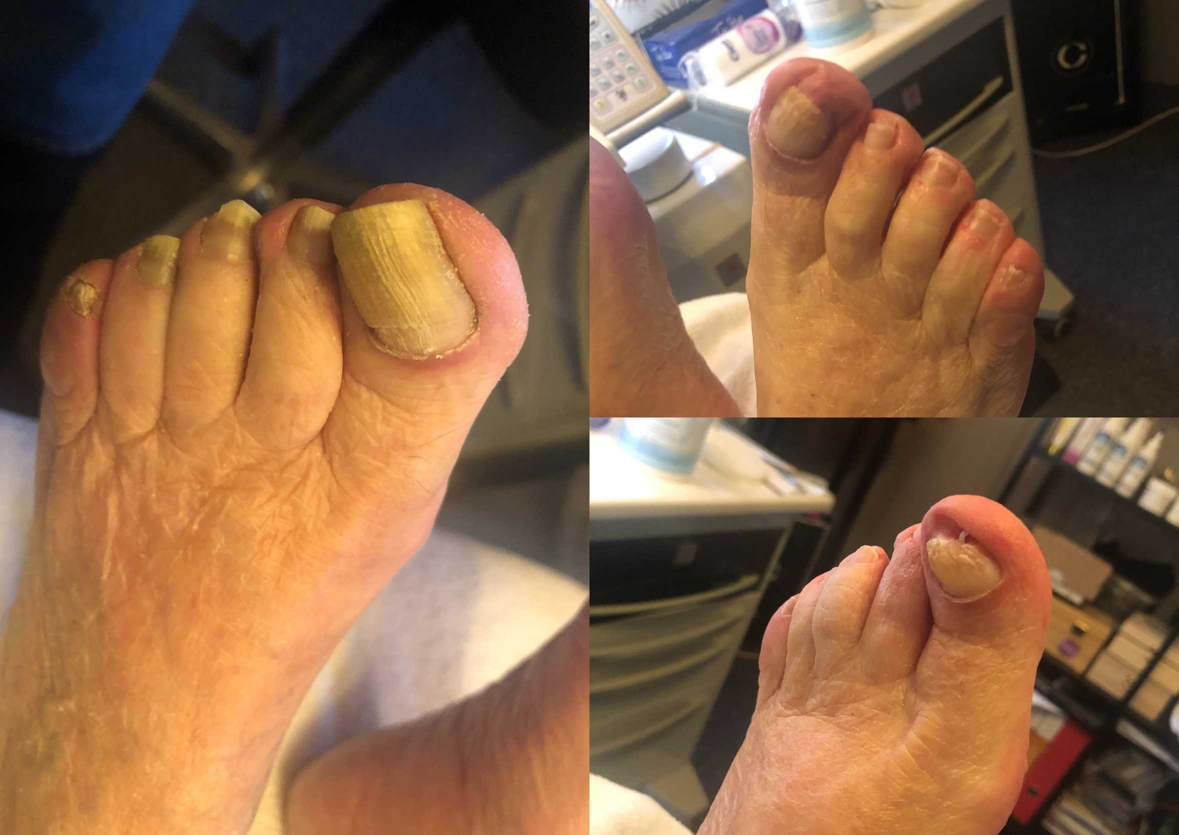 Medisch pedicure Hoenderloo