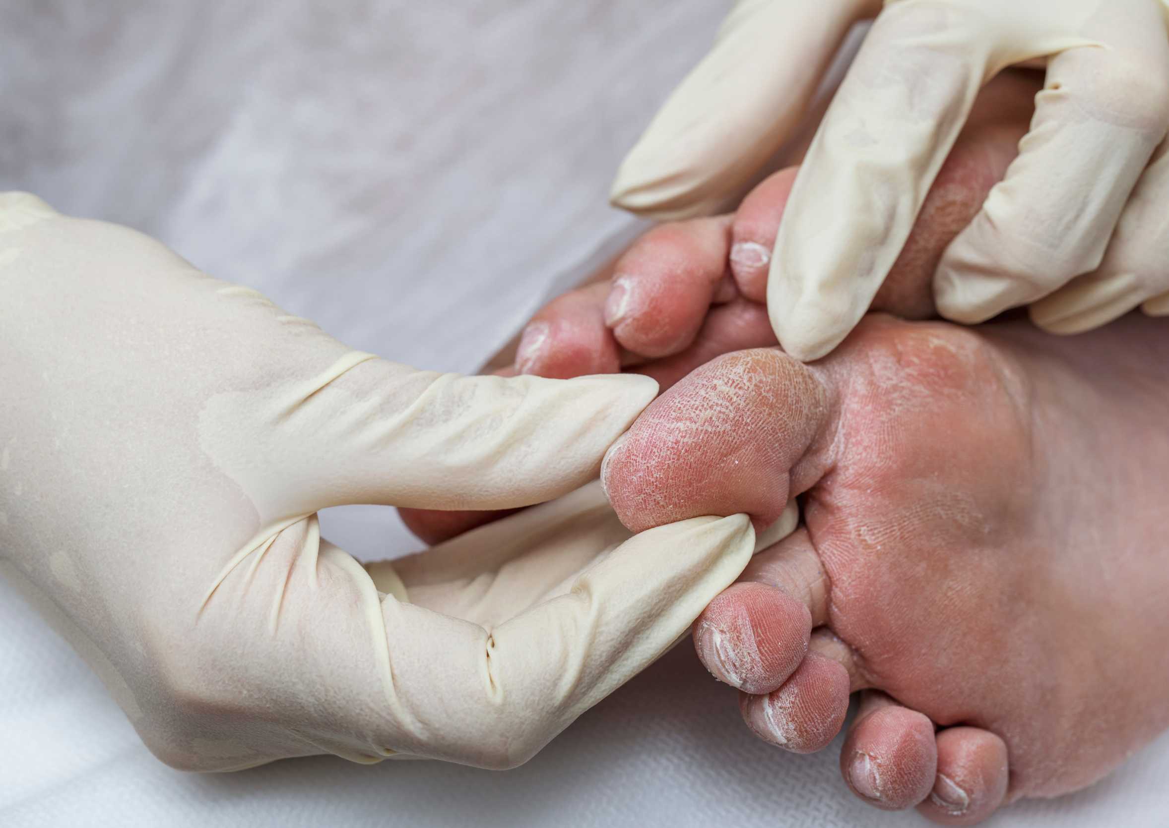 Medisch pedicure Hoenderloo