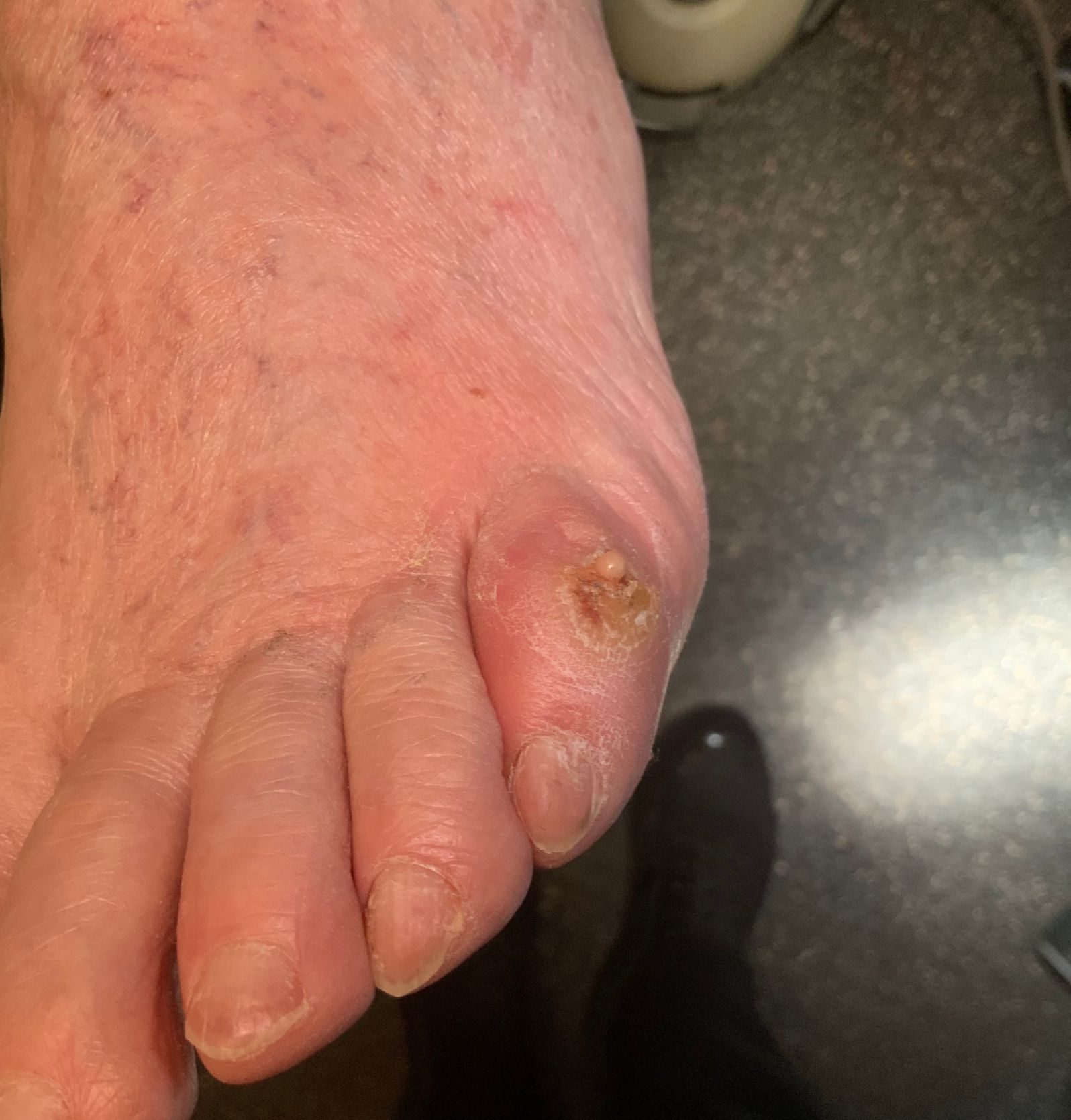 Medisch pedicure Hoenderloo