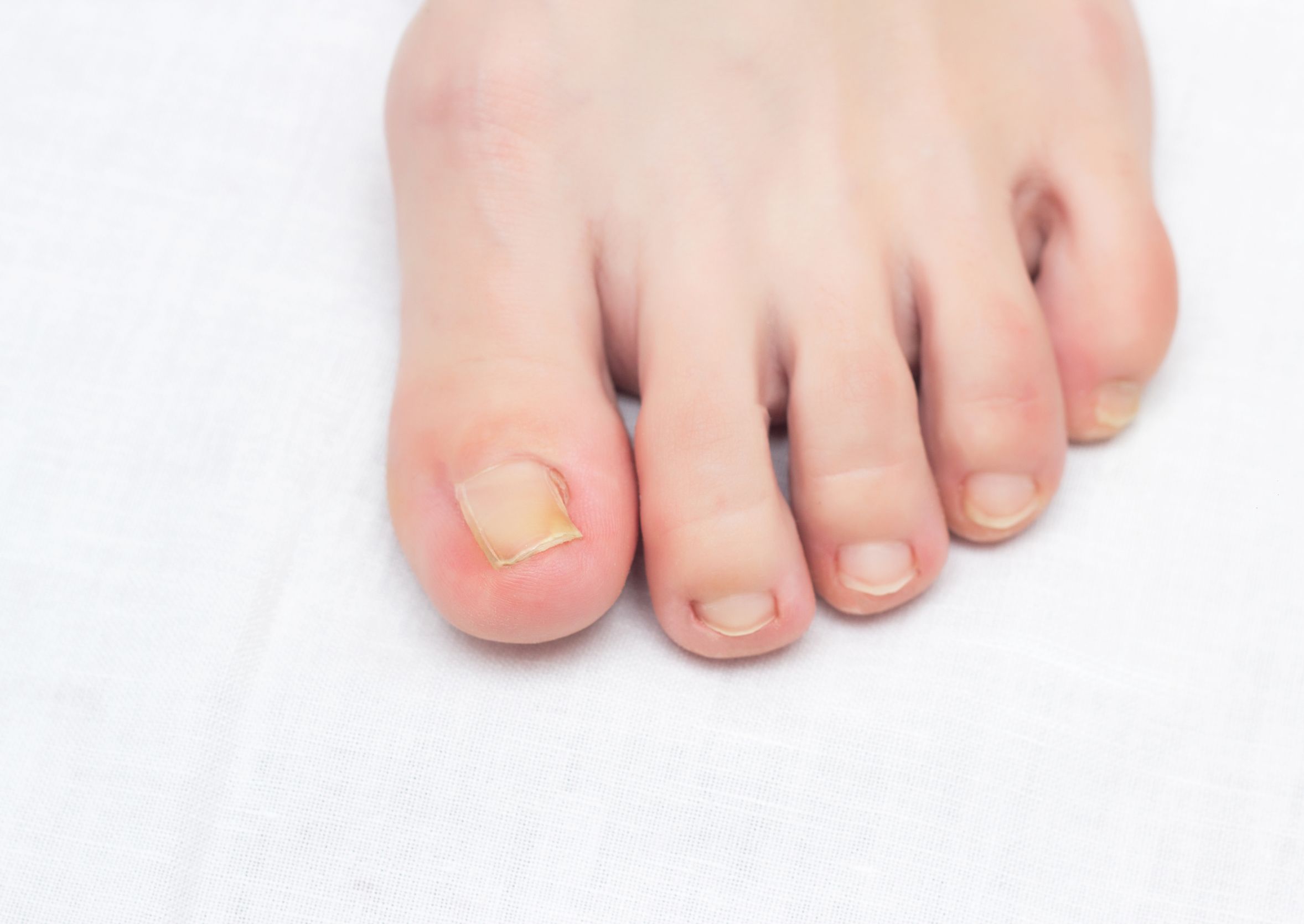 Medisch pedicure Hoenderloo